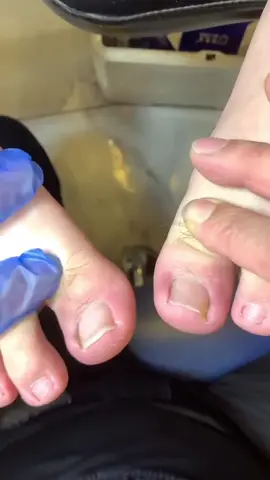 Ingrown toenails removal #fypシ #fyp #ingrowntoenail #pedicure #nails #usa 