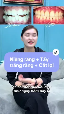Nha khoa Smile Hunter rất biết ớt vì đã được đồng hành cùng Tuyền trong suốt chặn đường Chinh phục nụ cười tự tin, rạng rỡ ấy ❤️ #smilehunter #nhakhoagovap #niengrang #taytrangrang #catloithammy #cườihởlợi 