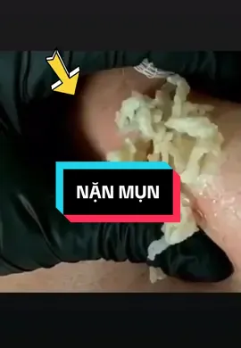 #nặn_mụn #lêthithuydung616 #chuyên_đtri_mụn_rỗ_tpvinh_nghệan #mdspa_chuyên_mụn_rỗ_tpvinh 
