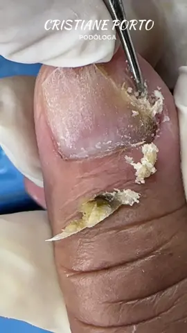 😱|  UNHA ENCRAVADA NA MÃO . . . #podologacristianeportopodologa #peelingquimico #peeling #nails #ingrowtoenail #magé #mage #piabetá #piabeta #guapimirim #podóloga #podólogo #podologa #podologo #podólogas #podologos #pé #pés #satisfaying #satisfatorio #satisfatório #viral #viralvideo #unhaencravada #peelingungueal #unhaencravada #unhaencravadanuncamais #unhainflamada #podologacristianeportopodologa #peelingquimico #peeling #nails #ingrowtoenail #magé #mage #piabetá #piabeta #guapimirim #podóloga #podólogo #podologa #podologo #podólogas #podologos #pé #pés #satisfaying #satisfatorio #satisfatório #viral #viralvideo #unhaencravada #peelingungueal #unhaencravada #unhaencravadanuncamais #unhainflamada #calo #AcreditaEVAI #pedicure #encravada #calosidades #alivio #satiafatory #podolo #podologia #pes #nails #fypage #unha 