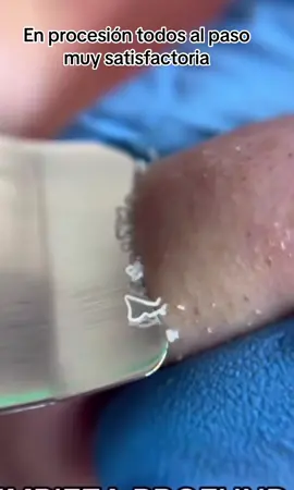Limpieza profunda de glándulas sebáceas en la nariz muy satisfactoria  #extractions #puntosnegros #acne #grasa #espinillas #granos #