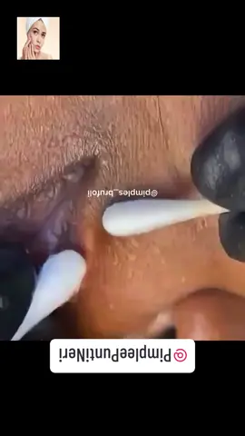 #squeeze #squeezeyuk #acne #pimple #pimplepop #blackhead #satisfying #foryoupage 120