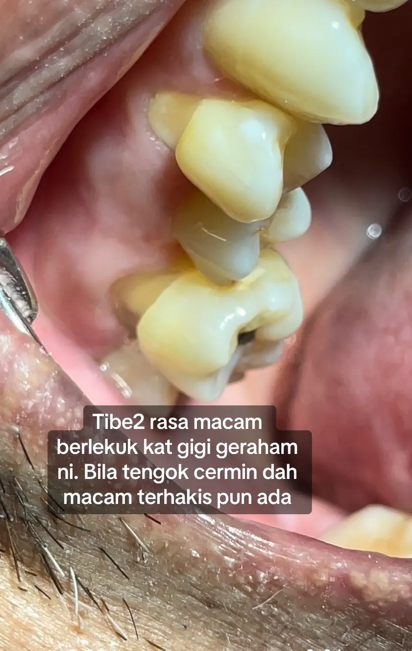 #abrasion #abfraction #gigiterhakis #hakisangigi #dentistpasirgudang #doktorgigipasirgudang #klinikgigipasirgudang #dentalclinicpasirgudang #bracespasirgudang #pasirgudang #pasirgudangjohor #shouldbeme #fypシ゚viral #fyp #fypage #CapCut #rawatanakarpasirgudang #scalingpasirgudang 