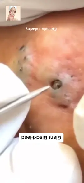 #squeeze #squeezeyuk #acne #pimple #pimplepop #blackhead #satisfying #foryoupage 168168