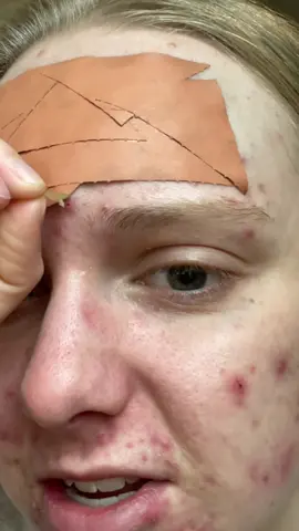 That one pimplepatch was INSANE #ACNE #peaceout #acnedot #pimplepatch #pimplepatchremoval #morningskin #acneskin 