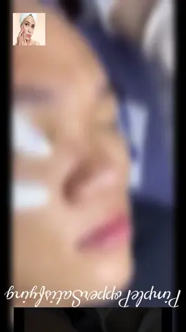 #pimple #pimplepop #acne #squeeze #skincare  #blackhead #satisfying #foryou 168