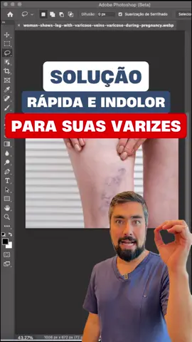 SOLUÇÃO IMEDIATA PARA AS SUAS VARIZES! 😱 É pessoal, não existe solução imediata, a menos que vocês façam alteração no Photoshop. 😬 Tratamentos para as varizes tem que ser personalizados, pensados de forma individual para cada paciente, visando sempre a melhora e a eficácia do tratamento. 😌 🚩 Não existe receita milagrosa, apenas estudos e tratamentos baseados na ciência!  👇🏻 Conhece alguém que precisa de uma solução rápida, eficiente e indolor? Compartilha esse vídeo com ela!