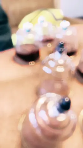 Say goodbye to lower back pain with Hijama Cupping! 🌿✨ Discover the natural remedy that can provide relief. Watch and learn!  . . . . #hertscupping #wetcupping #hijama  #HijamaCupping #NaturalHealing #LowerBackPainRelief #HolisticWellness #PainManagement #HealthyLiving #TikTokHealth #WellnessJourney #HolisticHealth #FeelGood #NaturalRemedies #SelfCare #HealthyHabits #PainFreeLife #MindBodySoul #HealthyChoices #PainRelief #DiscoverWellness #HealthTips #HolisticHealing #PainFreeLiving #NaturalTherapy #PainBeGone #HealthyBack #BackPainRelief #ChronicPain #SelfLove #WellnessWarrior #PositiveVibesOnly #TikTokHealthTips #FeelBetterNow #painfreedays 