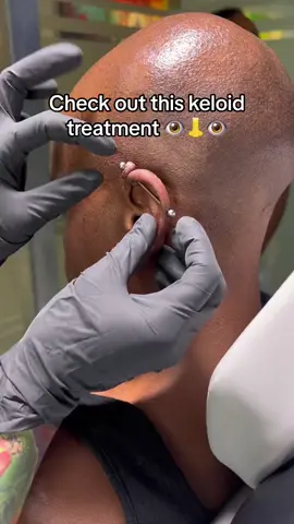 Keloid Challenge: See the Transformation! Our piercing artist takes on a massive keloid with Piercing Bump Oil. Witness the journey to smoother skin! 💎🌟 #KeloidTreatment #PiercingCare #skintransformation #aftercare #piercingaftercarespray #piercingbumptreatment #baselaboratories #piercingartist 