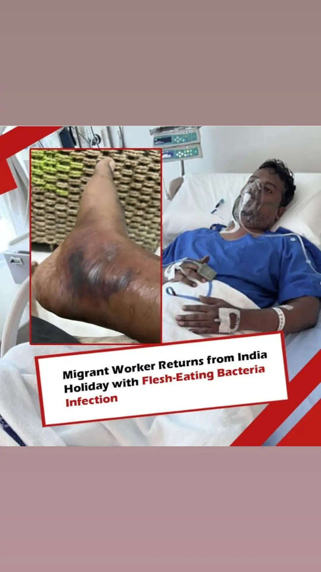 A migrant worker who went home to India for a holiday last month found himself infected with a flesh-eating bacteria. 42-yearold operations manager Amjath Khan, who has been working in Singapore for 13 years, said that he felt something amiss when he started feeling a pain in his right leg after his India holiday. He saw a doctor and was diagnosed as suffering from gout. However, his 