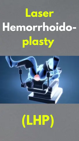Laser Hemorrhoido-plasty (LHP) #laser #hemorrhoidoplasty #LHP #3danimation #treatment #surgery #watach #foryoupage