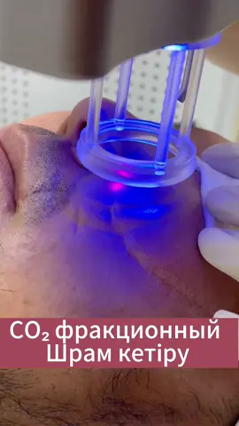 Шрамдарды кетіруге болады Фракционный СО2 лазер аппаратымен🔥 #косметологическоеоборудование#косметологическиеаппараты#аппаратыдлякосметологов#аппаратыдлякосметолога#косметологиямосква#хочуврек#втренде2021#втренде2021рек#врек#косм