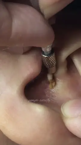 Giant blackhead #relaxing #pimple #explore #tiktoklongs #satisfying #fyp #foryou 