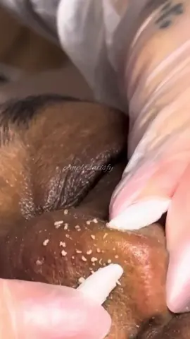 Super satisfied 🤗 #foryou #fyp #satisfying #tiktoklongs #explore #pimple #pourtoi 
