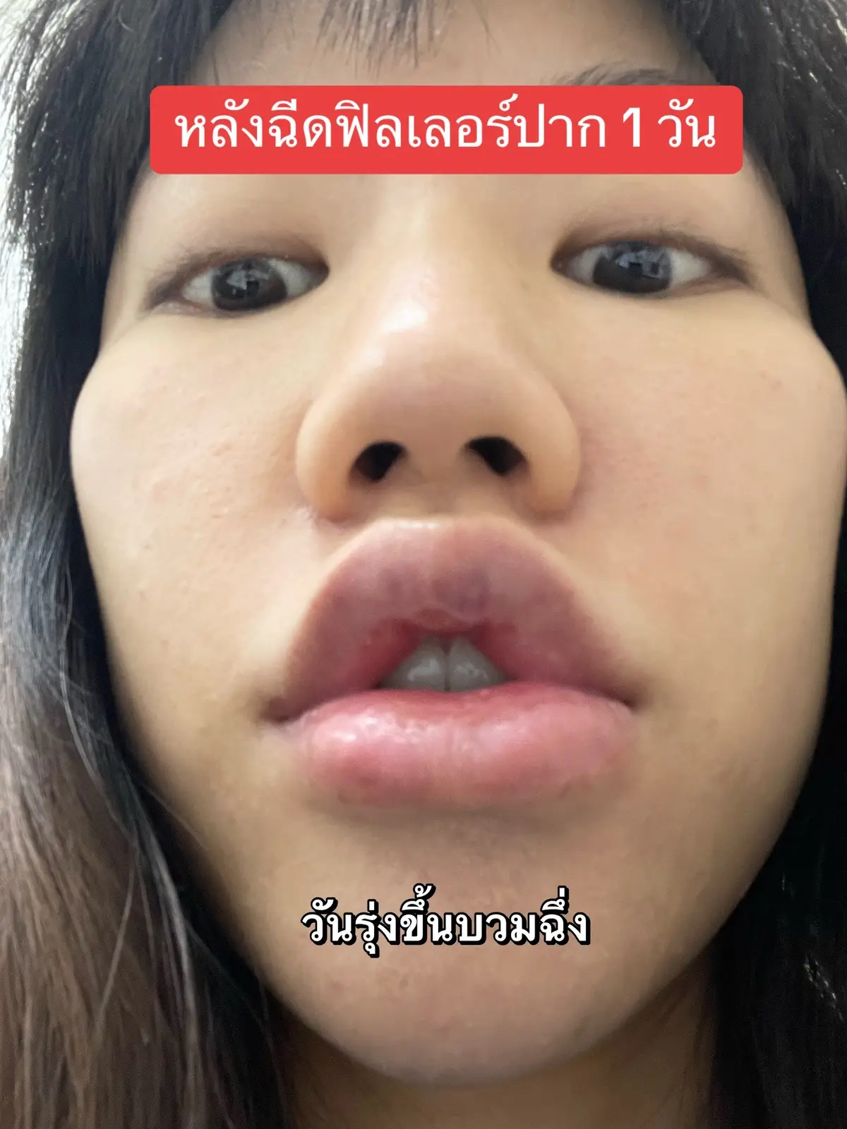 รีวิวฟิลเลอร์ปาก 🥹  7 แบ๊งเทา #รีวิวฟิลเลอร์ปาก #ฉีดปาก #babyfacebkk #หมออุ้มbabyface 