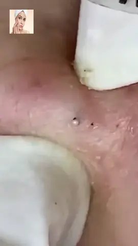 #squeeze #squeezeyuk #acne #pimple #pimplepop #blackhead #satisfying #foryoupage 133