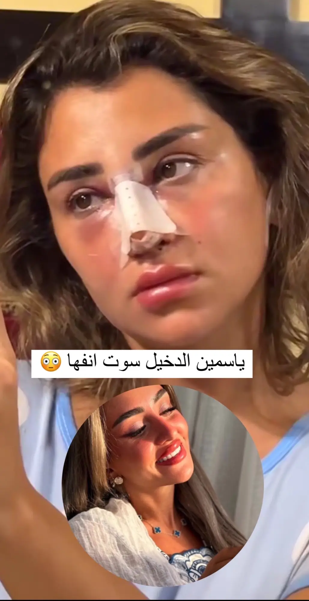 متحمسسسسة لللنتيجة 🥹🥹🥹🤍🤍🤍🤍 ‎ #تجميل #تجميل_الأنف #عيادات_تجميل #foryoupage #fyp