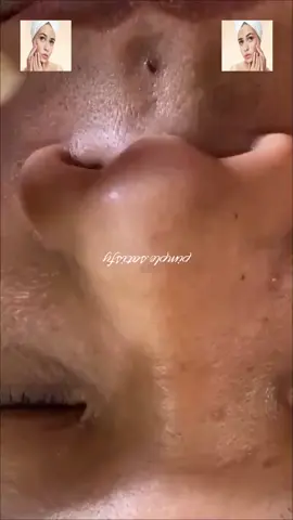 #squeeze #squeezeyuk #acne #pimple #pimplepop #blackhead #satisfying #foryoupage 23