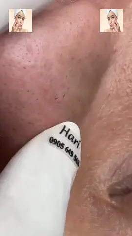 #squeeze #squeezeyuk #acne #pimple #pimplepop #blackhead #satisfying #foryoupage 239