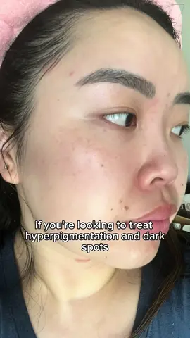 @Sachi States of Skin ® ily 🫶 I’ve tried SO many products to fade dark spots and this is by far my favorite. *pr, but I’d repurchase in a heartbeat ✨