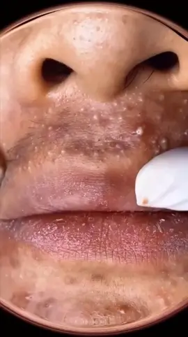 #acne #pimple #pourtoi #pimplepop #face #viral #fyb #popping #blackdots #foryoupage #blackheadsremoval #satisfyingvideo #pimplepopper #blakhead #foryou #fyp  