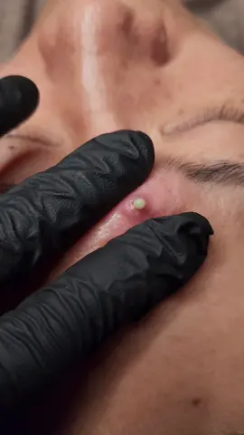 #pimplepopper #pimple #extractions #cystpopping #acnetreatment #medicalaesthetics #foreverauraskincare#Acne#PimplePopper#SkinCare#ClearSkin#Pimple#Blackheads#Whiteheads#AcneTreatment#SkinCareRoutine#Dermatology#BeautyTips#Extraction#SkinHealth#Zit#SkincareAddict#PimplePopping#HealthySkin#AcneFree#CloggedPores#Blemishes#GlowingSkin#BeautyRoutine#PimpleRemoval#ClearComplexion#SkinCareTips#Breakouts#PimpleTreatment#AcneAwareness#Dermatologist#SkinIssues 