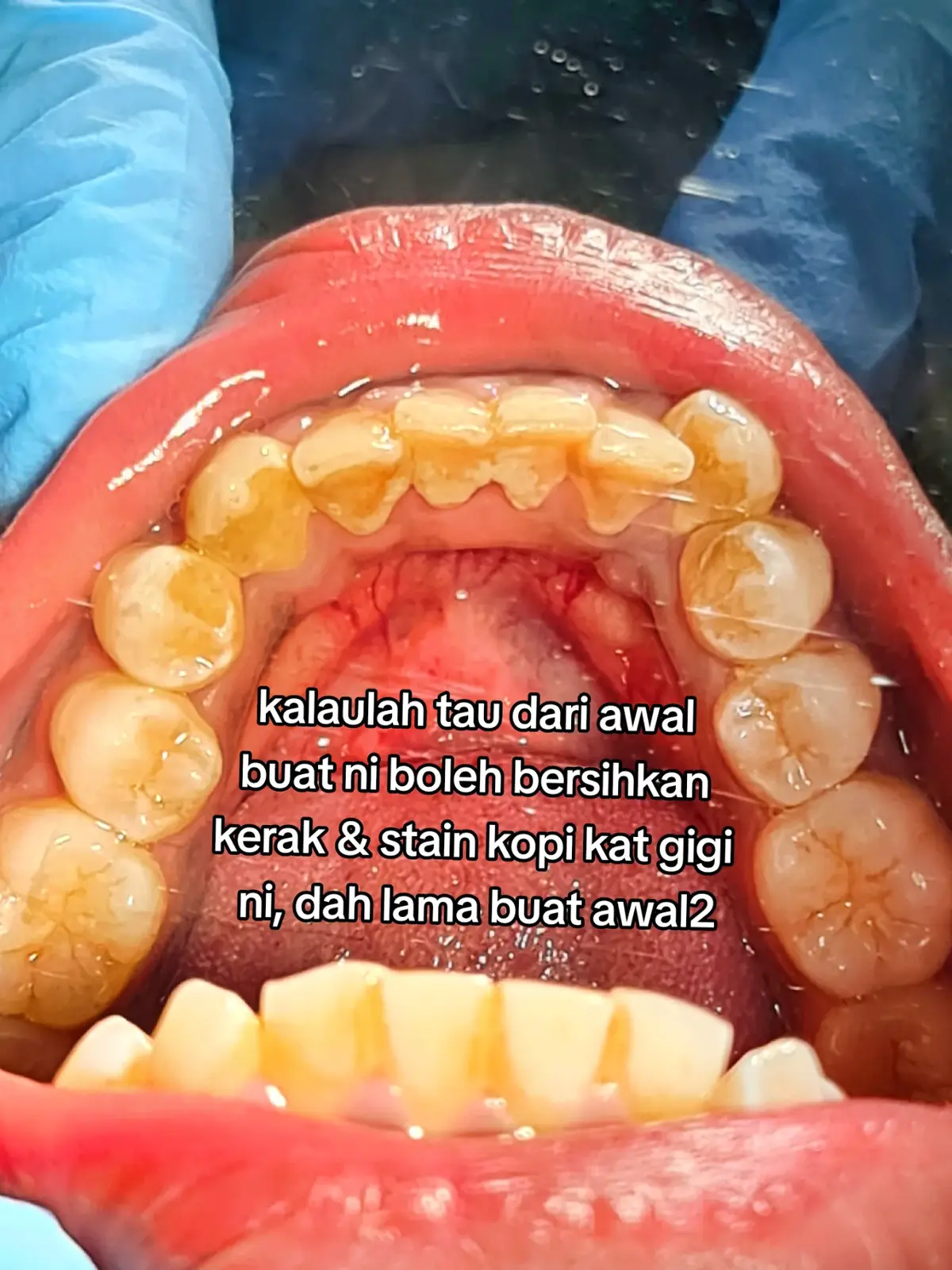 #scaling #scalingteeth🦷 #scalinggigi #pasirgudangjohor #pasirgudang #doktorgigimalaysia #doktorgigijohor #doktorgigi #doktorgigi #fypシ #fypシ゚viral #foryoupage #dentist #dentistpasirgudang #jbstyle🔥 #jbstyle 