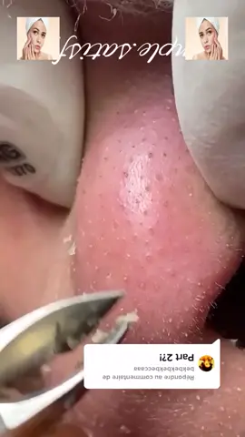 #squeeze #squeezeyuk #acne #pimple #pimplepop #blackhead #satisfying #foryoupage 77