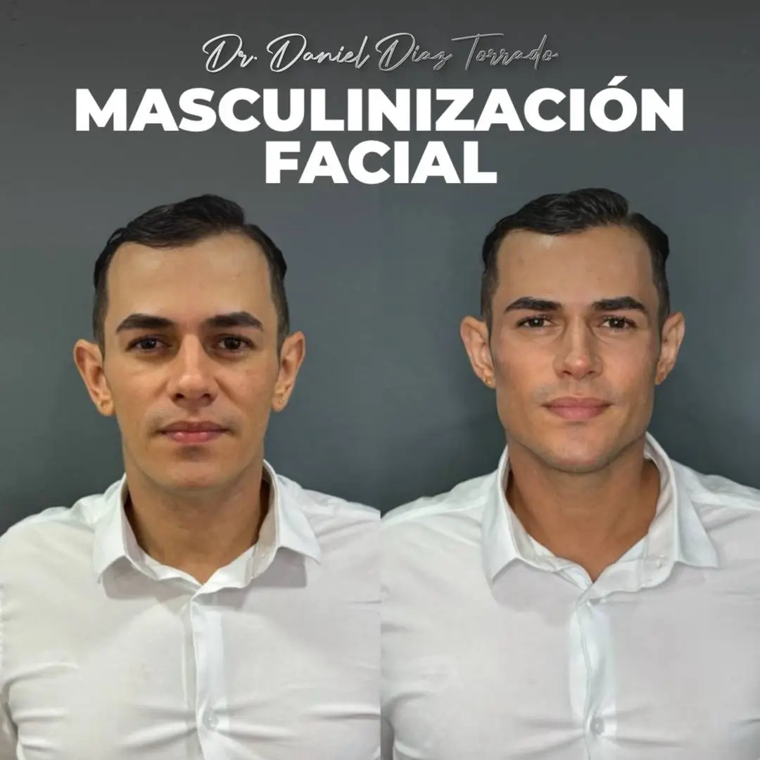 Masculinizacion facial 