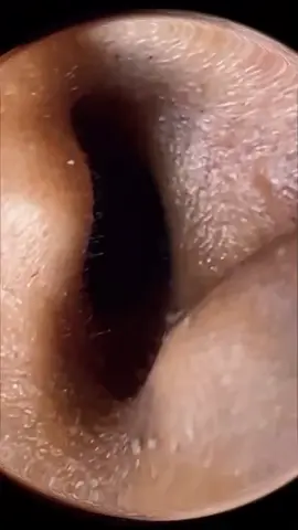#squeeze #squeezeyuk #acne #pimple #pimplepop #blackhead #satisfying #foryoupage 17