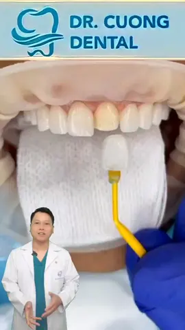 Quá trình dán răng sứ Veneer - Bác sĩ Cường #bacsicuong #learnontiktok #rangsu #bacsicuongrangsu