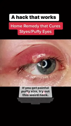 #hack #medicalhack #stye #puffyeyes #homeremedies #pharmacistadvice #garlic #homeremedies 