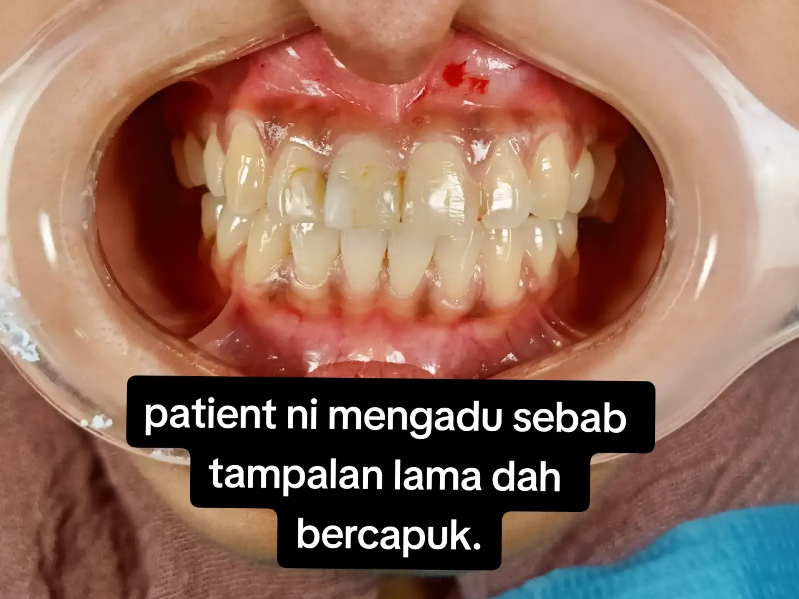 #jbstyle #jbstyle🔥 #dentistpasirgudang #dentist #doktorgigi #doktorgigimalaysia #doktorgigijohor #foryoupage #fypシ #pasirgudangproblem #pasirgudangjohor #pasirgudang #composite #compositeveneers #tampalamkomposit #komposit 