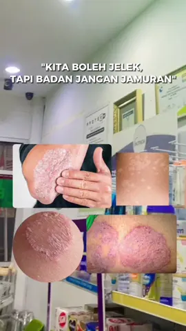 Yuk yang kulitnya ada masalah jamur, kita punya solusinya! 👍 #fyp #fypシ #k24indonesia #apotekk24indonesia #obat #farmasi #rekomendasiobatjamur #jamurkulit 