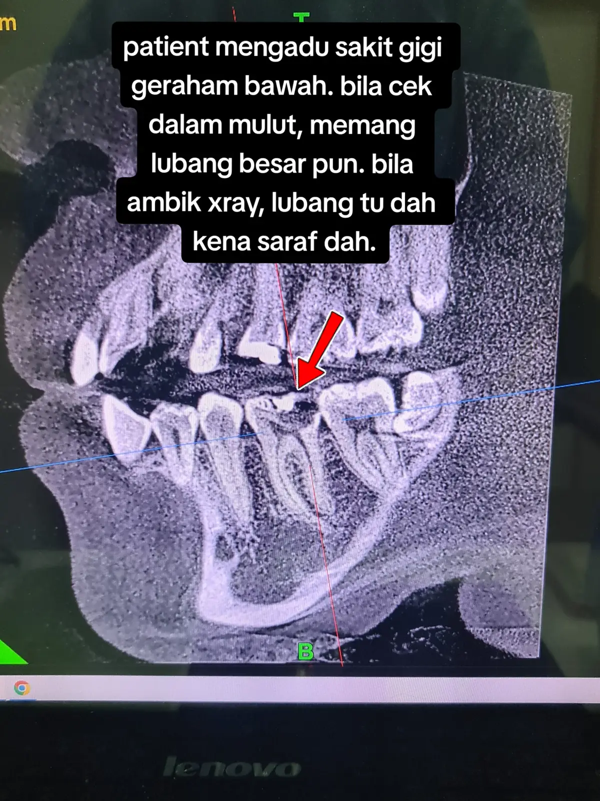 #rawatanakar #rootcanal #rootcanaltreatment #pasirgudang #pasirgudangjohor #pasirgudangproblem #fypシ #foryoupage #doktorgigijohor #doktorgigimalaysia #doktorgigi #dentist #dentistpasirgudang #jbstyle🔥 #jbstyle #