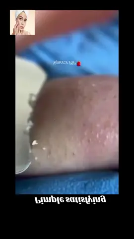 #squeeze #squeezeyuk #acne #pimple #pimplepop #blackhead #satisfying #foryoupage 17