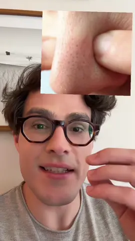 Filamento sebaceo nos poros x cravos (acne) qual a diferença entre eles e qual melhor tratamento pra essa condicao? consultar com dermatologista sempre vem antes de se automedicar!