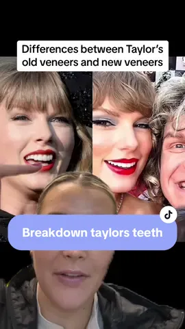 A few things! Canines are fixed! Positive smile arc, whiter teeth! #taylorswift #veneers #taylorswiftteeth #swifties 
