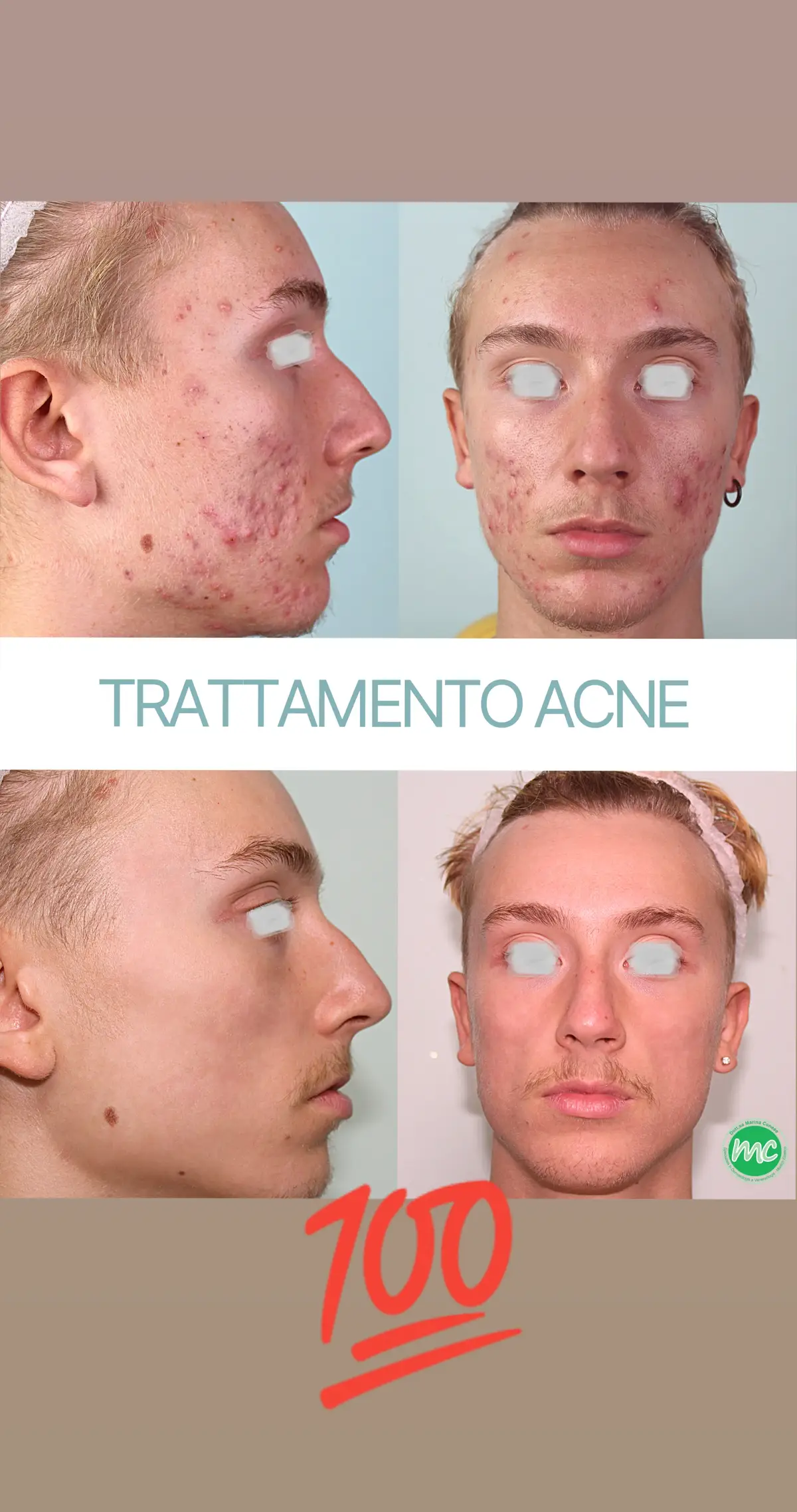 🏆🥇 Abbiamo vinto ancora una volta!!💪🥳 Facciamo gli auguri a questo bellissimo ragazzo per il suo volto nuovo! 💚 ____________________ #acne #primaedopo  #acnemotivation #motivation  #dermatologia #dermatologiaestetica  #cremegaleniche #cosmesi #cosmesisartoriale #skincare #acnefree #acneproblems #acnechallenge #acnetreatment #acnepositivity #acneskincare #medicinaestetica  #beforeafter #beforeandafter #challengeyourself #dottmarinaconese #dottssamarinaconeseforever♥️ #medicoestetico 