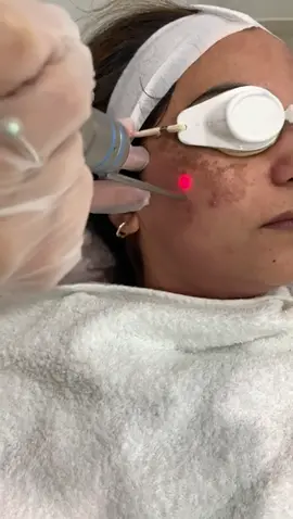 Get rid of pigmentation  . . #Pigmentation #ClearSkin #Lahore #Faceprp #acnesolution #acnetreatment #facetreatment #glow #cleanskin #pakistan #trending #aesthetics #aestheticsclinic #karachi #faislaabad #gujrat #islamabad #dermatologist #beauty 