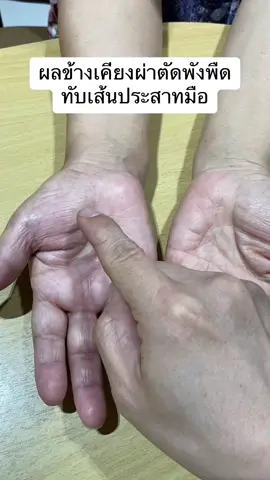 ผลข้างเคียงการผ่าตัดพังผืดทับเส้นประสาทมือ 1 เจ็บแผลเป็น 2 ชาไปตลอด 3 แผลติดเชื้อ ผ่าตัดไม่ได้ดีเสมอไปนะครับ #ผลเเทรกซ้อนการผ่าตัด #พังผืดทับเส้นประสาทข้อมือ #ด็อกเตอร์หมอหมี 