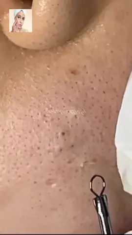 #squeeze #squeezeyuk #acne #pimple #pimplepop #blackhead #satisfying #foryoupage 167