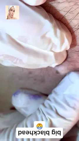 #squeeze #squeezeyuk #acne #pimple #pimplepop #blackhead #satisfying #foryoupage 67