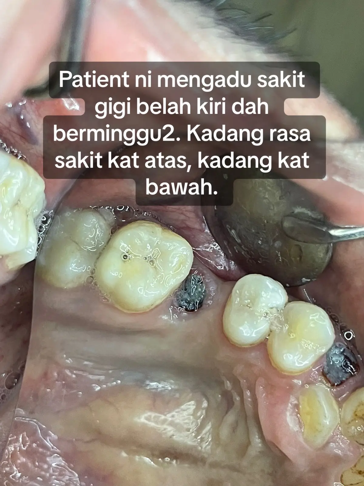 #dentistpasirgudang #klinikgigipasirgudang #doktorgigipasirgudang #fypシ゚viral #shouldbeme #fyp #fypage #jbstyle #pasirgudang #pasirgudangjohor #jb #dentalclinicpasirgudang #toothextraction #caries #cariesdental #gigiberlubang