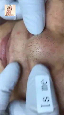 #squeeze #squeezeyuk #acne #pimple #pimplepop #blackhead #satisfying #foryoupage 67