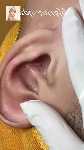 #squeeze #squeezeyuk #acne #pimple #pimplepop #blackhead #satisfying #foryoupage 117