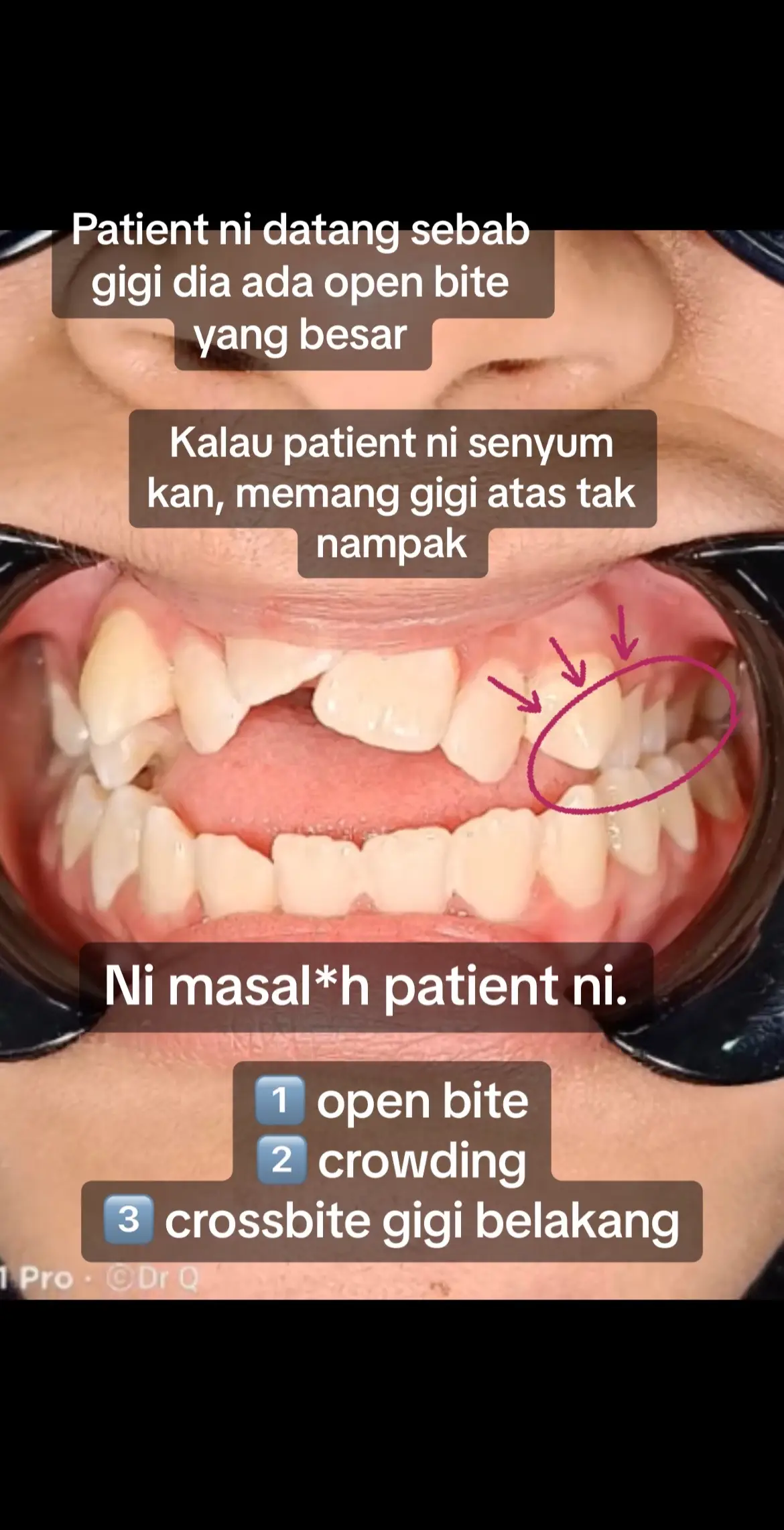 #openbite #openbiteproblem #openbitecorrection #crowding #crossbite #dentistpasirgudang #doktorgigipasirgudang #dentalclinicpasirgudang #klinikgigipasirgudang #fypシ゚viral #shouldbeme #fypage #fyp #pasirgudang #pasirgudangjohor #braces 