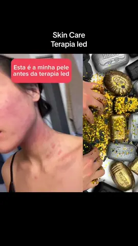Terapia led com rotina skin care 🔥🔥😍😊❤️ #harmonização #pele #skincare #harmonizaçãofacial #pelesaudavel #cuidadoscomapele #skin #terapialed #produtosdapele #pele #ledtherapy 