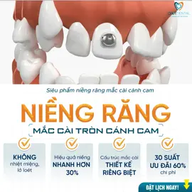 Bạn nào có nhu cầu niềng loại này thì báo mình nhé!