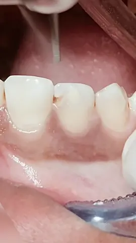 Composite restoration upper lateral teeth #dentist #dental #dentista #teeth #tooth #composite 